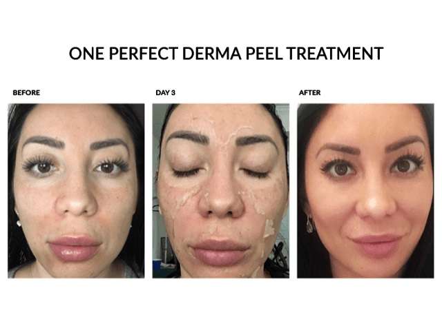 1771253572_Perfect-Derma-Peel-Before-and-After-1