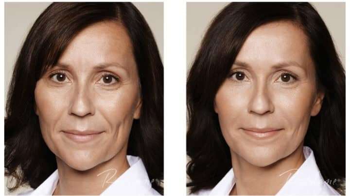 1771253639_restylane-refyne-before-and-after-patient-2-1 Restylane Refyne Under Eye Filler image 1