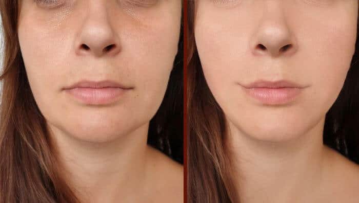 reshaping-of-the-chin-and-lower-mouth-area-1