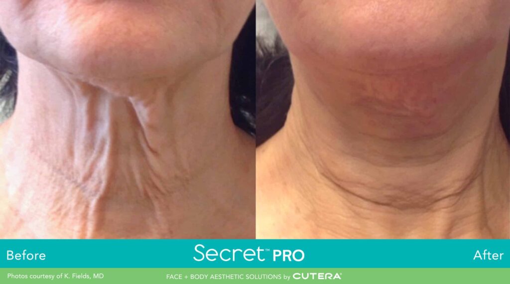 secret-pro-non-surgical-neck-face-lift-1