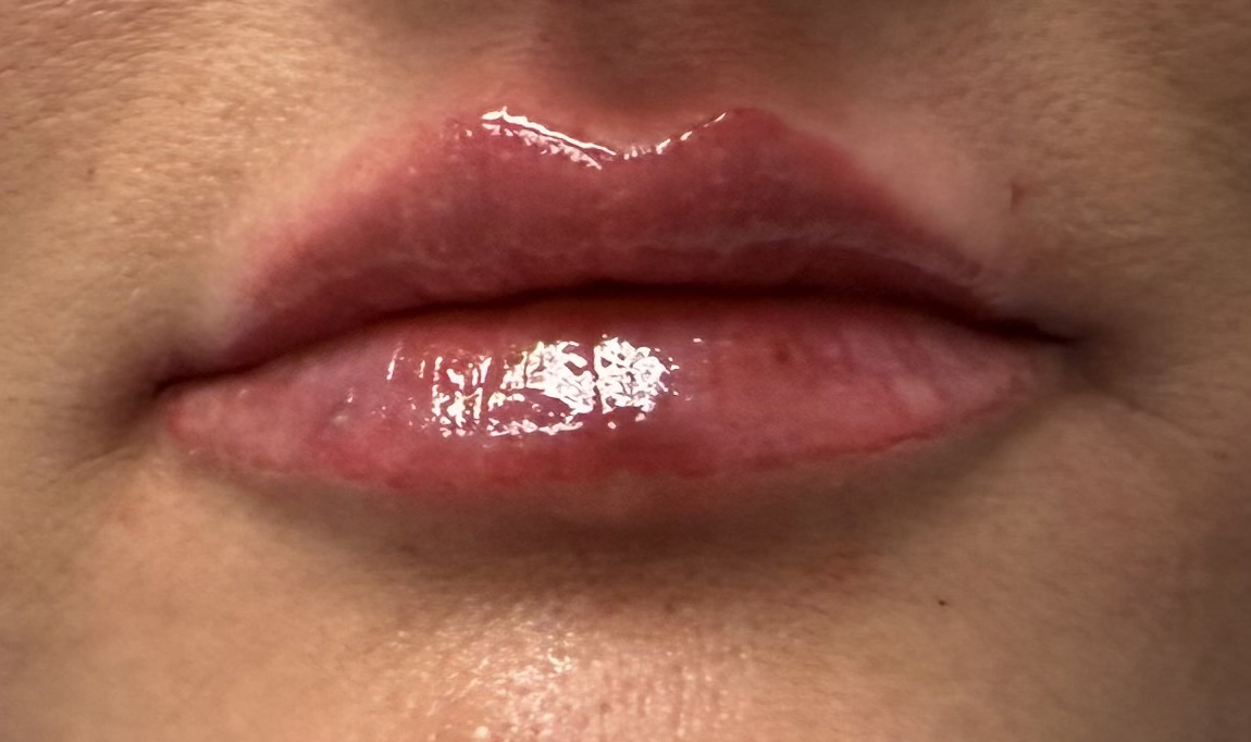After Image: Lip Filler - front