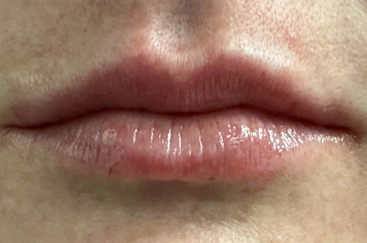After Image: Lip Filler - front