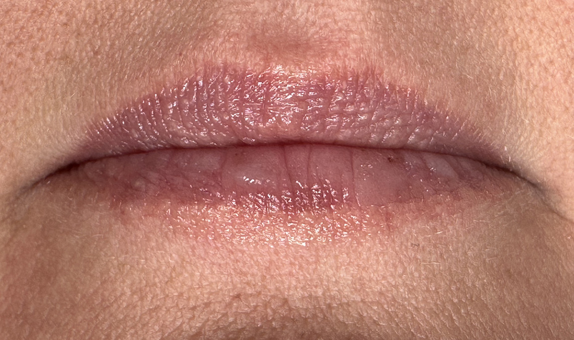 Before Image: Lip Filler - front