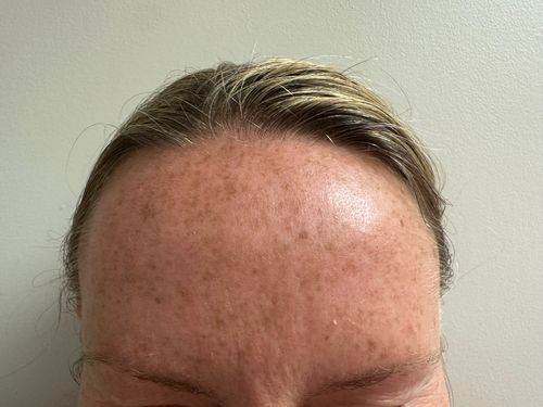 After Image: Botox - front