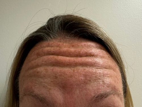 Before Image: Botox - front