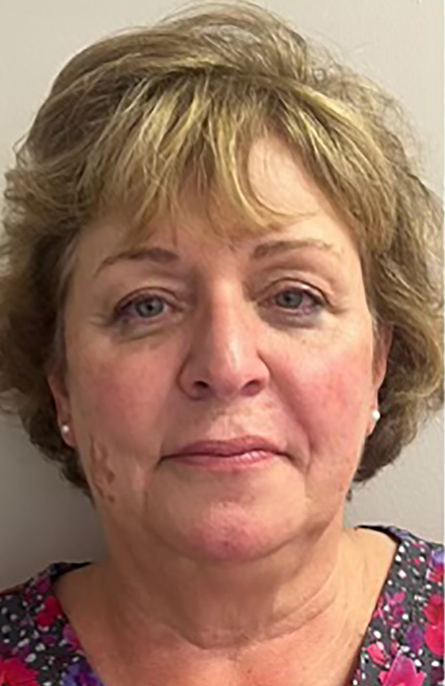 After Image: Filler & Sculptra - front