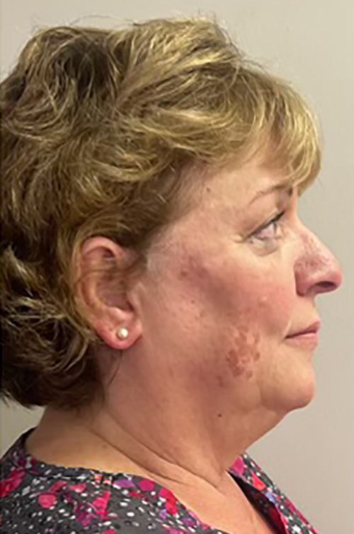 After Image: Filler & Sculptra - right-side