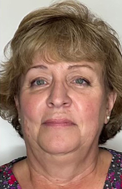 Before Image: Filler & Sculptra - front