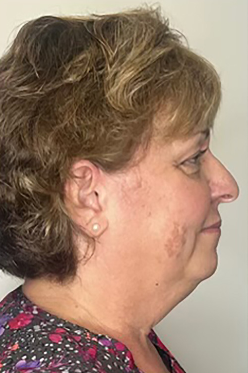 Before Image: Filler & Sculptra - right-side