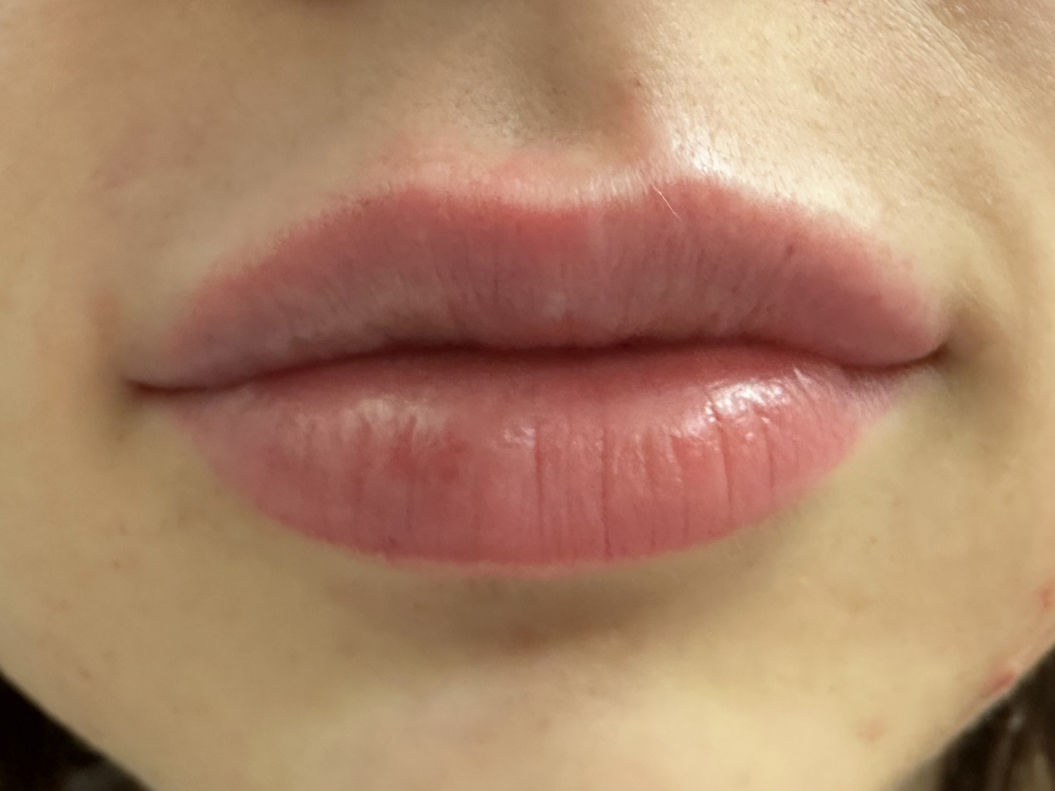 After Image: Lip Filler - front