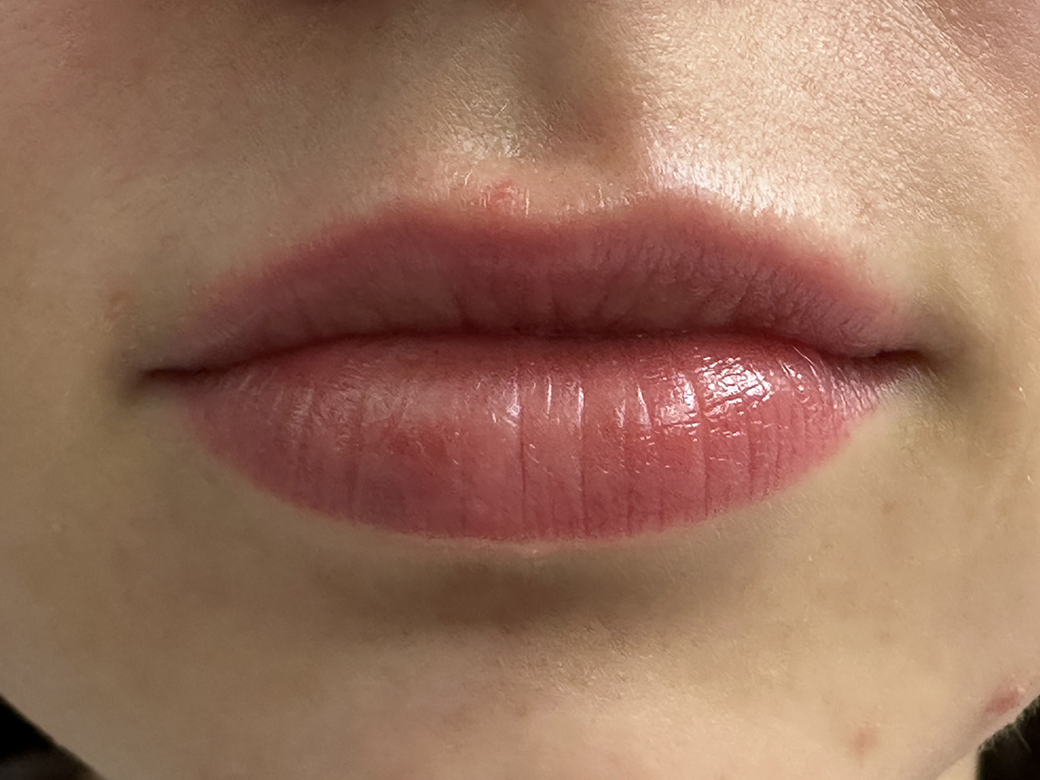 Before Image: Lip Filler - front