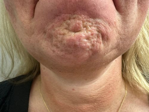 Before Image: Neurotoxin - front