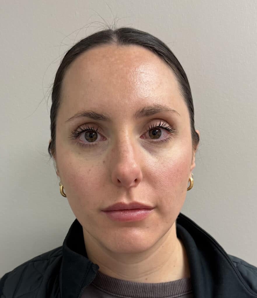 After Image: Botox - front