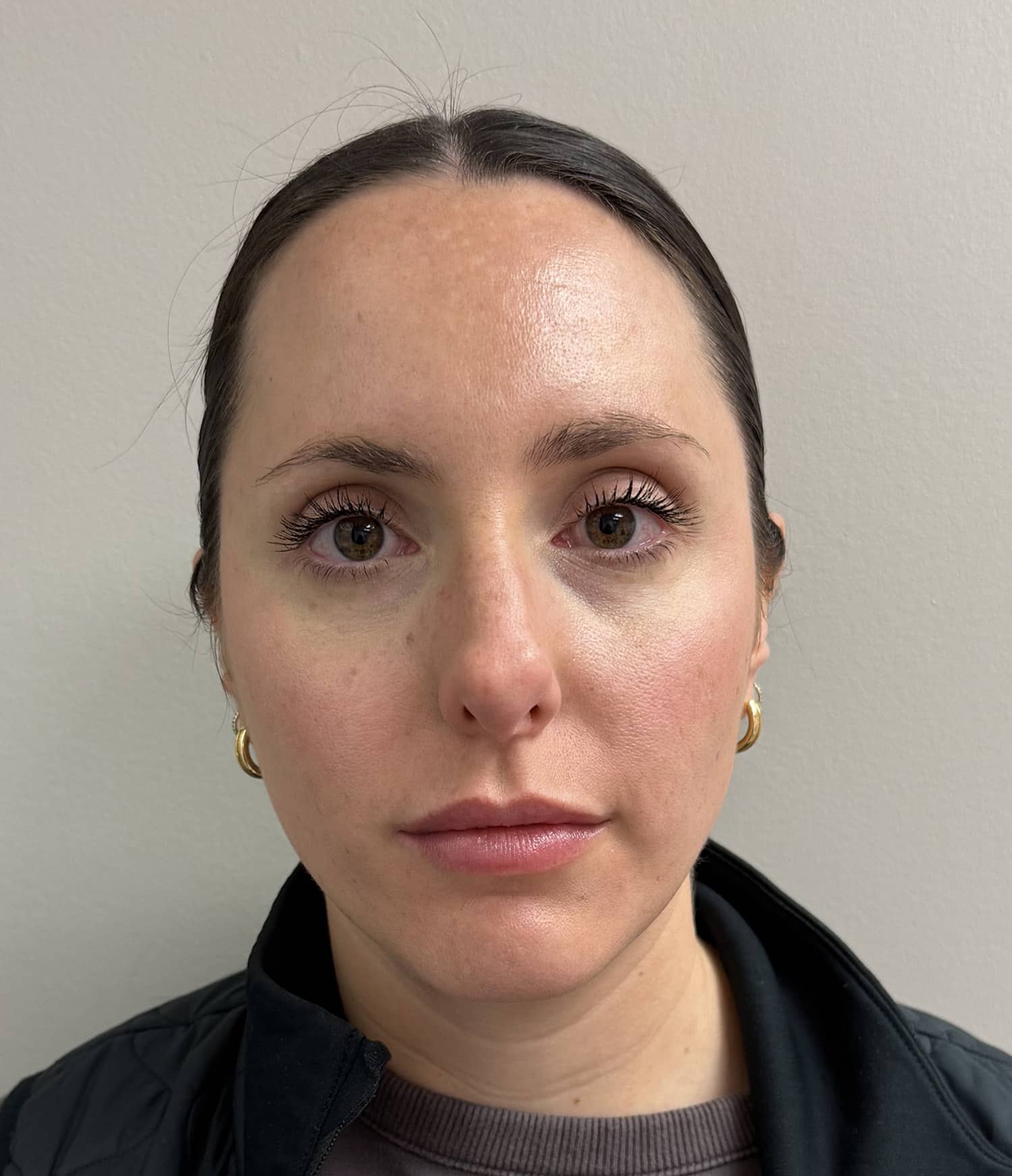 After Image: Botox - front