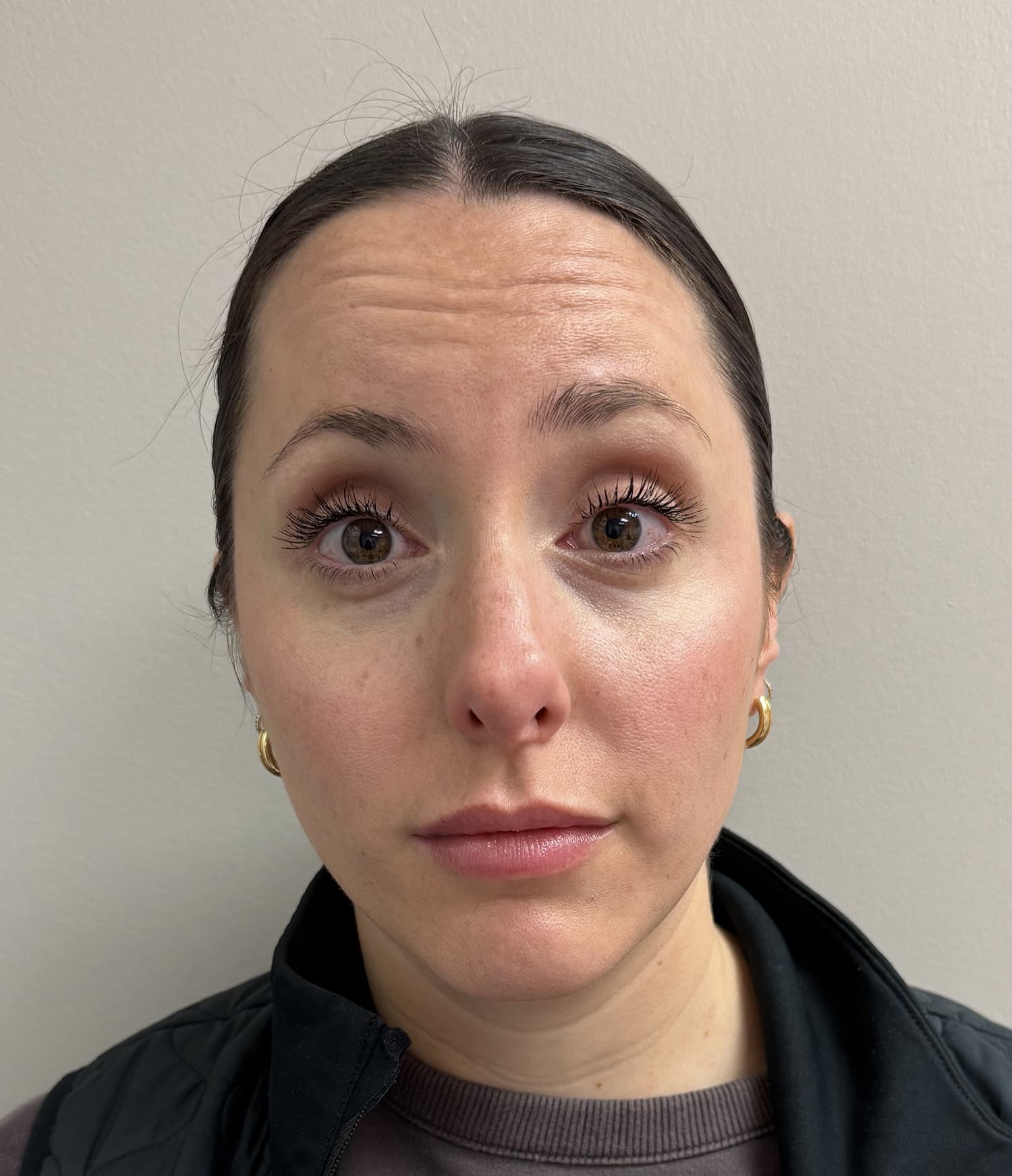 Before Image: Botox - front