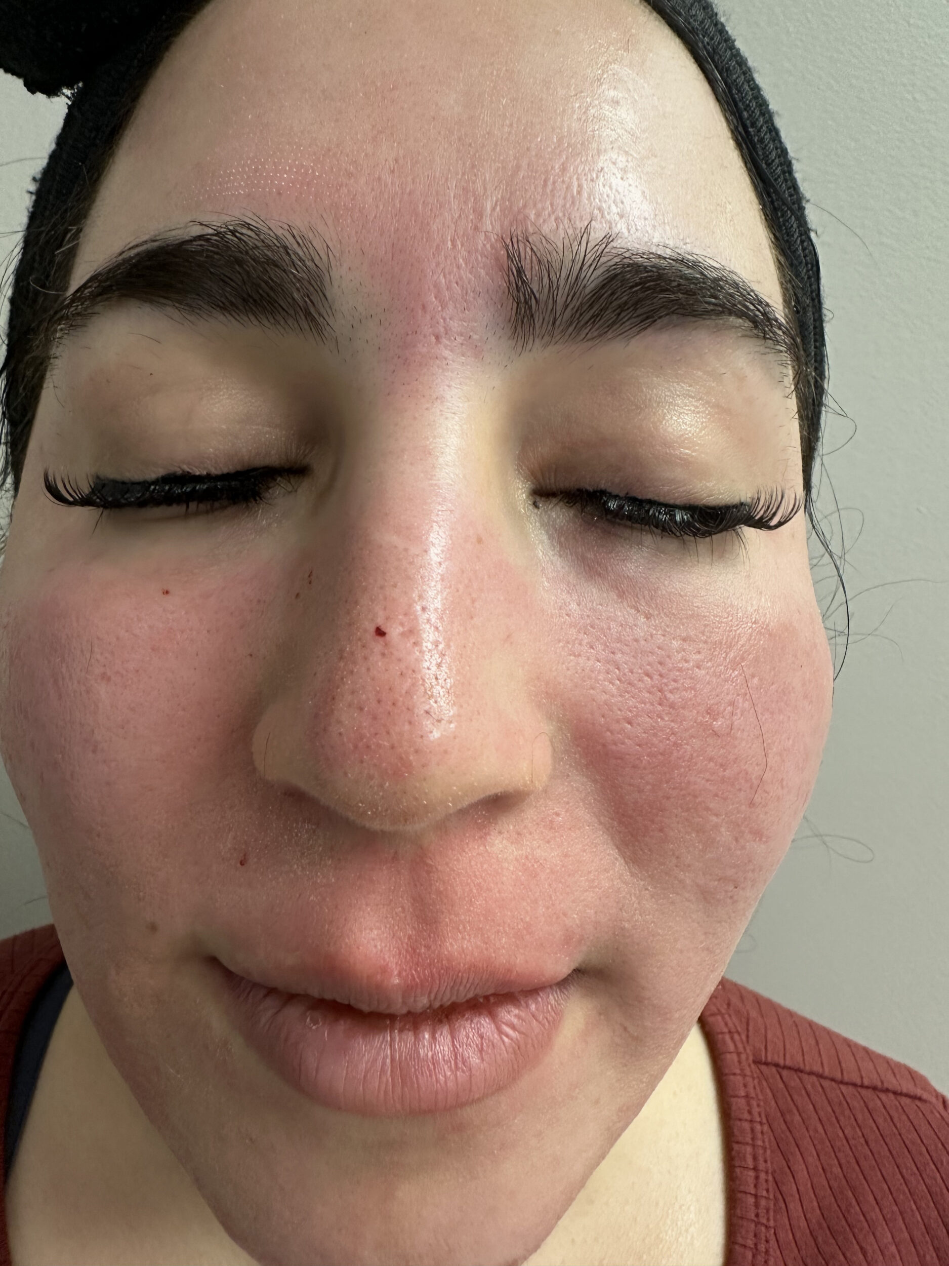 After Image: Microneedling - front