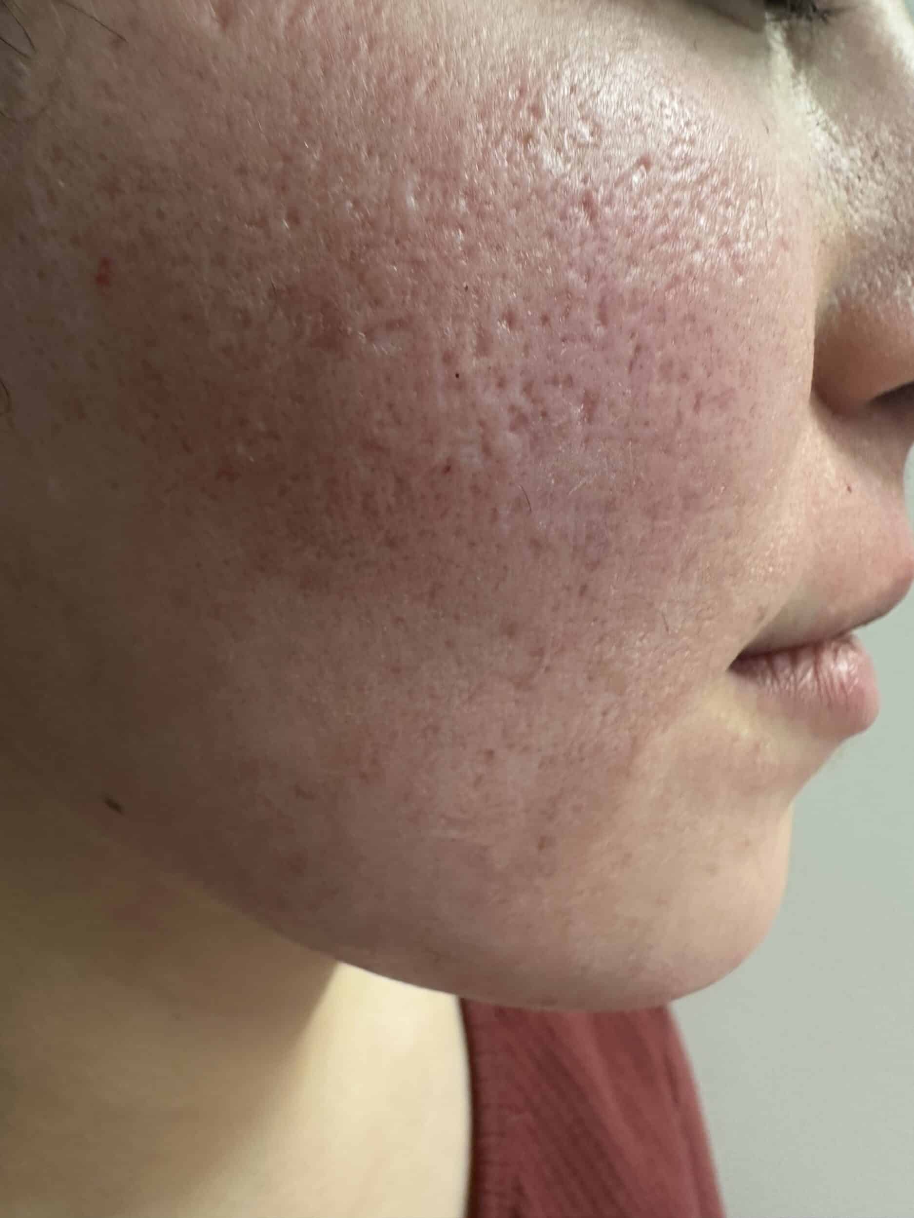 After Image: Microneedling - other