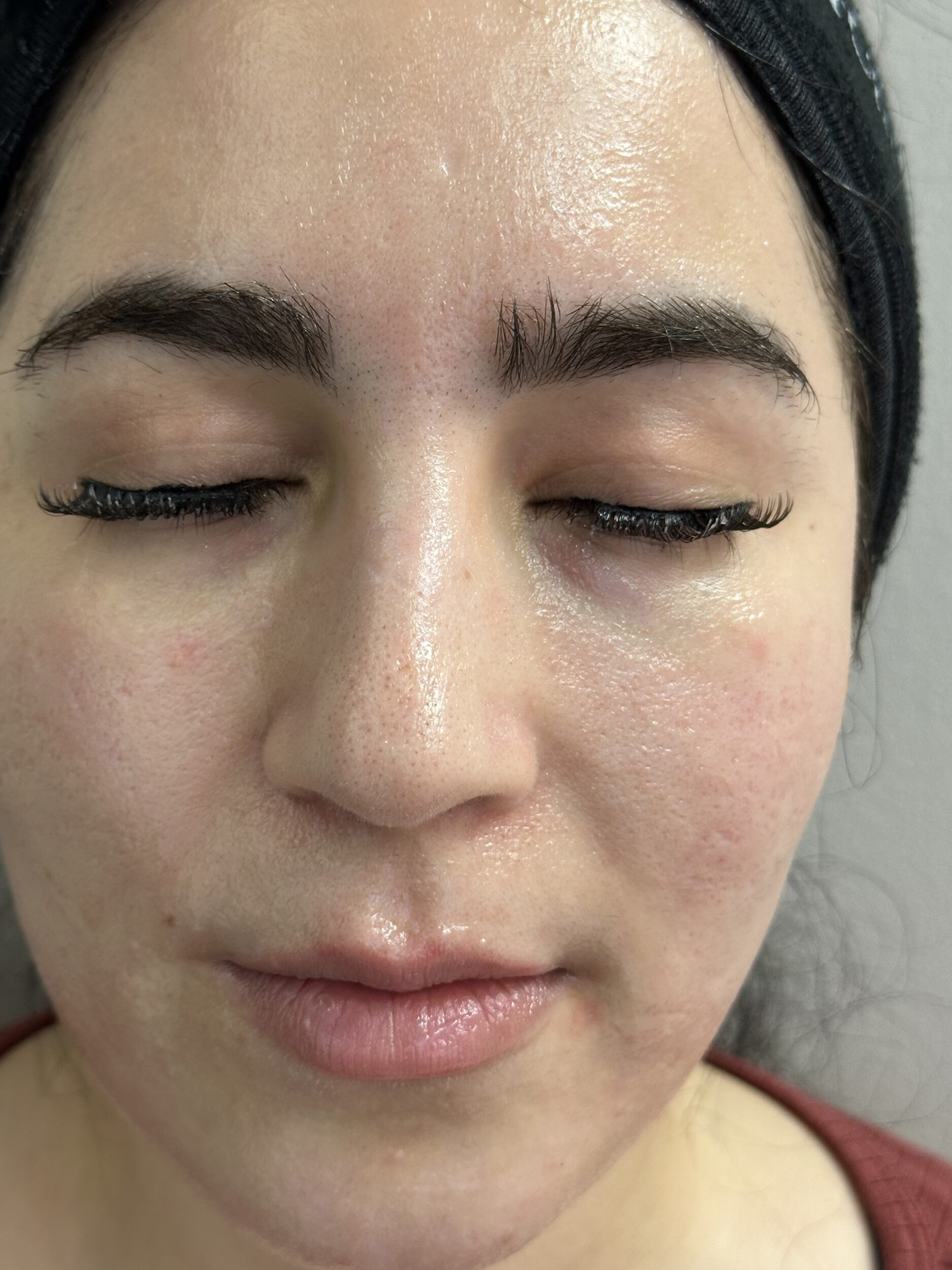 Before Image: Microneedling - front