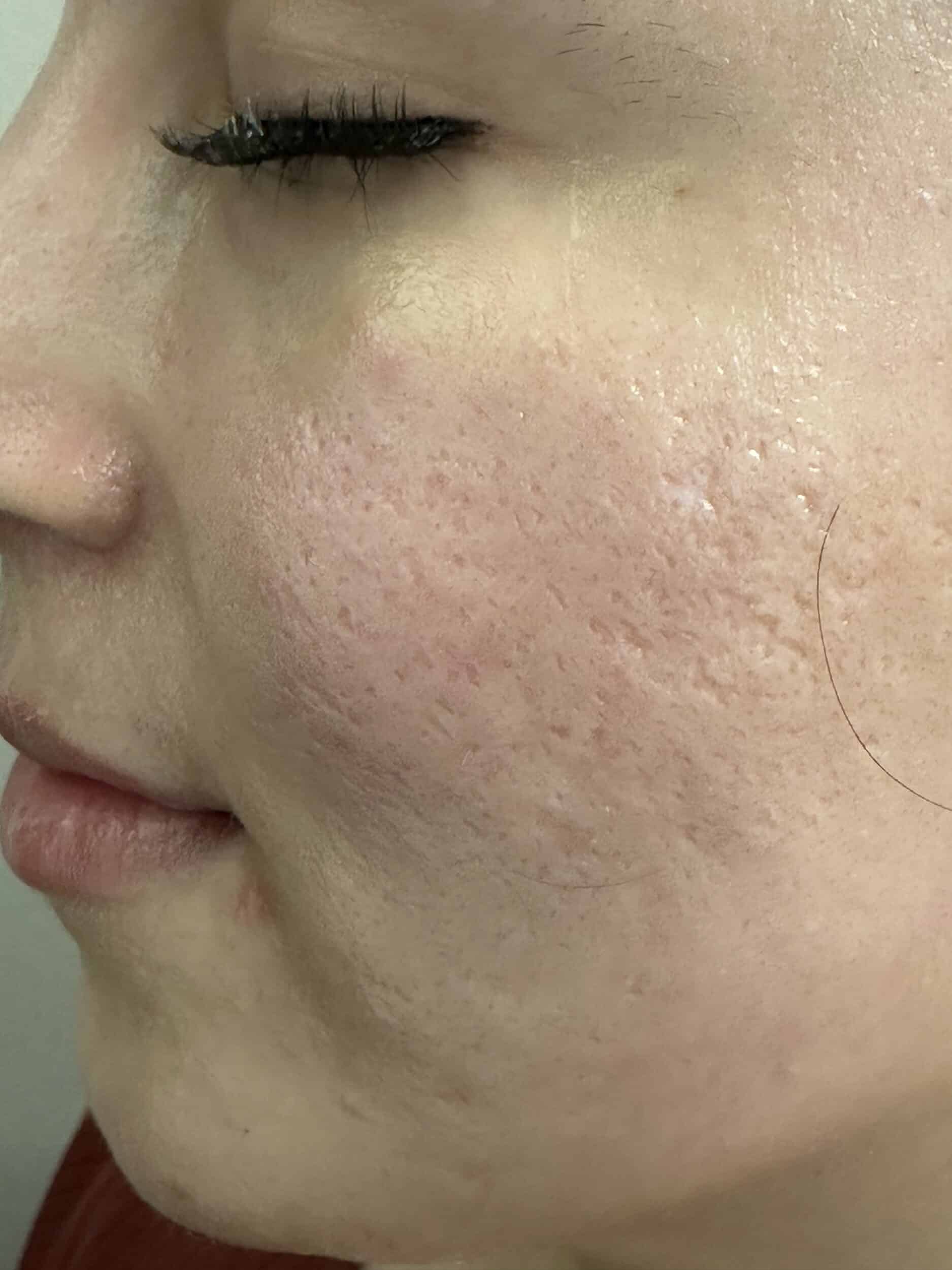 Before Image: Microneedling - other