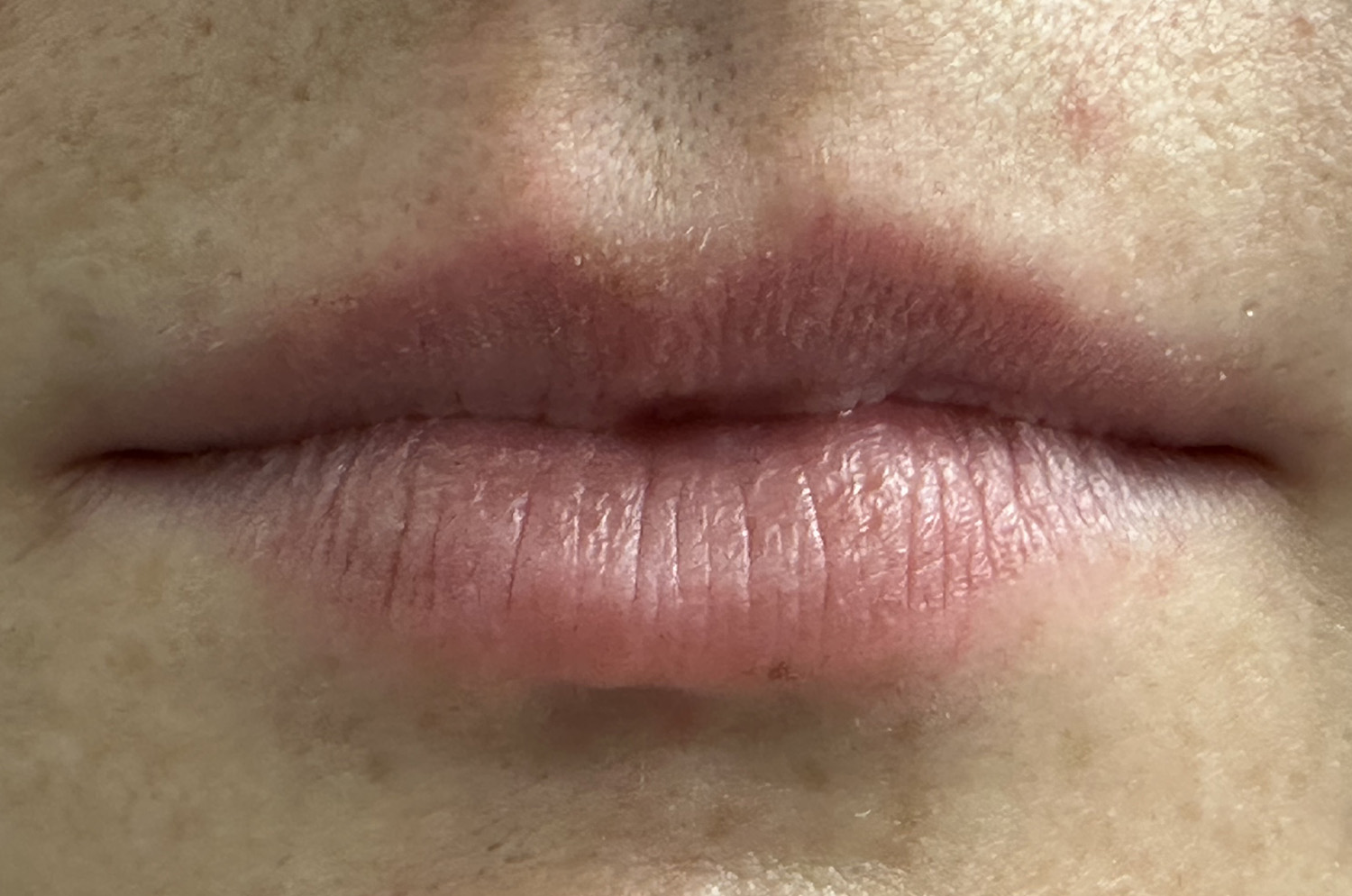 Before Image: Lip Filler - front